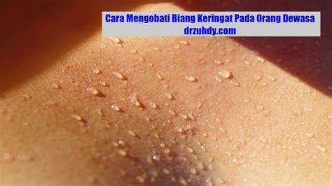 Cara Mengobati Biang Keringat Pada Orang Dewasa