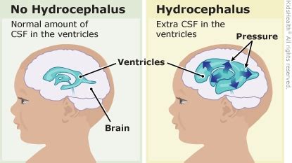 Hydrocephalus (for Parents) | Nemours KidsHealth