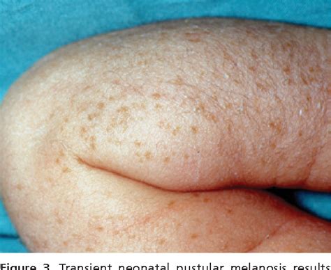 Transient Neonatal Pustular Melanosis