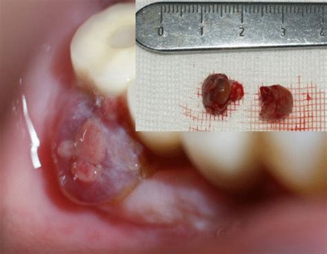 Pyogenic granuloma associated with a dental implant | Download Scientific Diagram