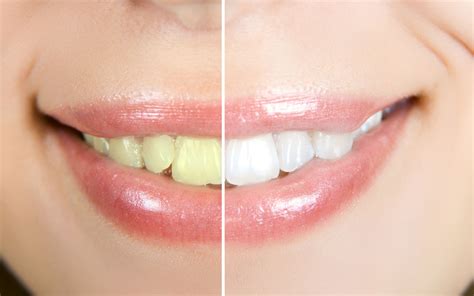 3 Tips to Prevent Teeth Stains - Tamiami Dental Center