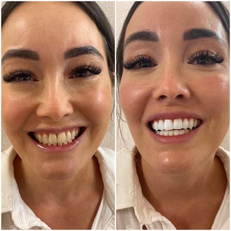 In-Office Teeth Whitening | Dr Monica Scheel Dermatology, Kailua-Kona, HI