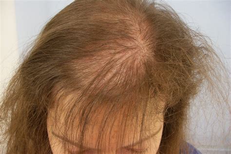 Alopecia femminile: cos'è e come si cura