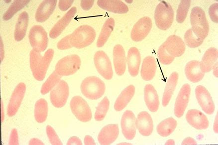 Hello USA: elliptocytes