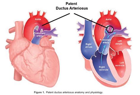 Anaesthesia for patent ductus arteriosus ligation in children : WFSA - Resources