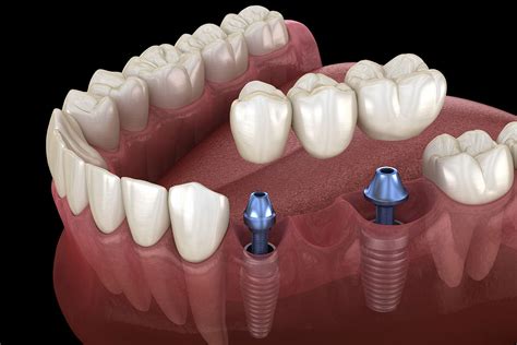 Dental Bridge vs Implant - Pros and Cons and How To Choose | Somerset Dental On James