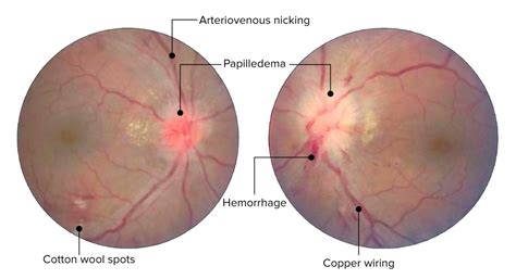 Hypertensive Retinopathie - E-Learning mit Lecturio