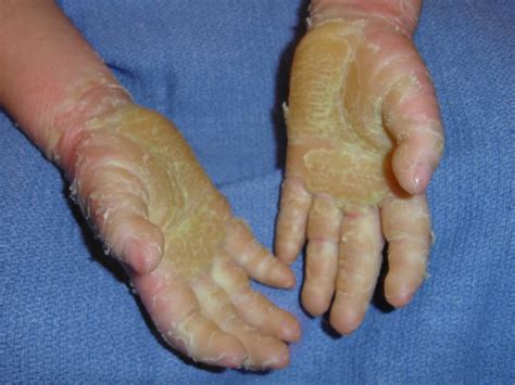 Hyperkeratosis definition, causes, prognosis & hyperkeratosis treatment