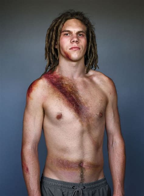 10 Powerful Pictures Of Car Crash Survivors Who Want To Raise Awareness ...