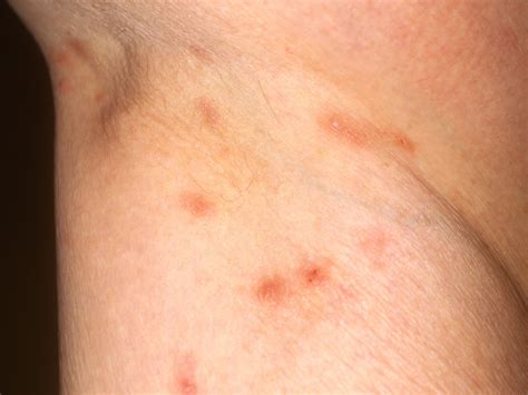 Rashes That Look Like Scabies: Causes, Symptoms, And