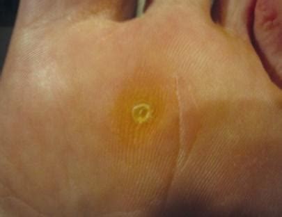 Corn or Wart?? - Hunter Podiatry Services