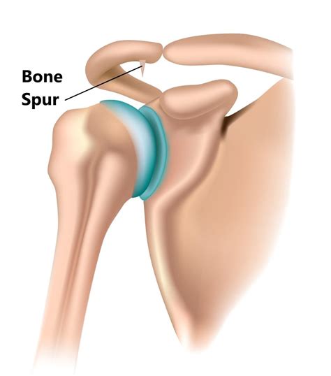 Shoulder Impingement - My Family Physio