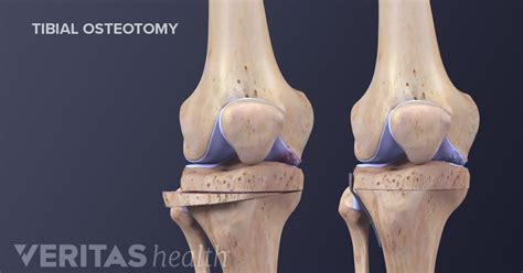 Knee Osteotomy Recovery