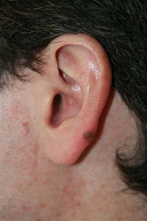Skin Cancer on Ear - Best Life and health Tips and tricks