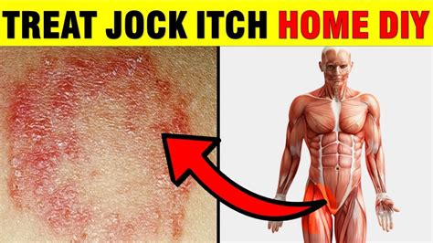 Groin Fungal Infection Remedies – Jock Itch - Epic Natural Health