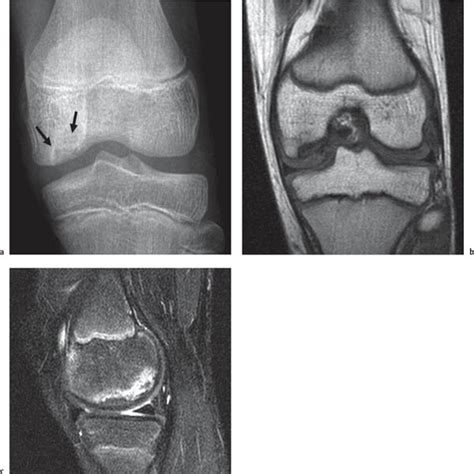 Epiphysis: Supernumerary Epiphyseal Ossification Centers | Radiology Key