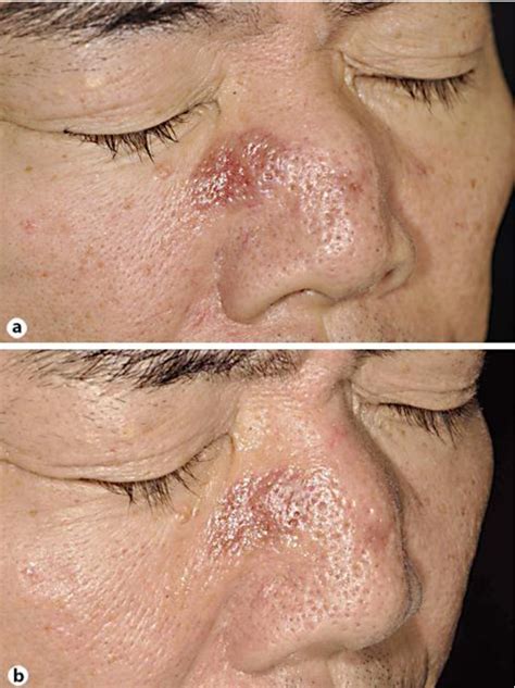 Figure 1 from Successful Treatment of Granuloma Faciale with Topical Tacrolimus: A Case Report ...