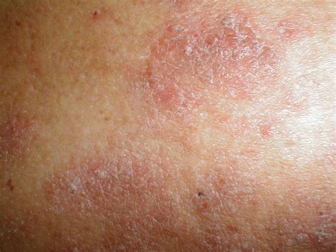 lichen simplex chronicus treatment adults - pictures, photos