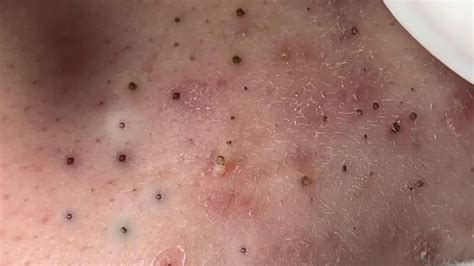 Huong Da Nang Acne Treatment #355 | Blackheads popping, Acne treatment, Poping pimples