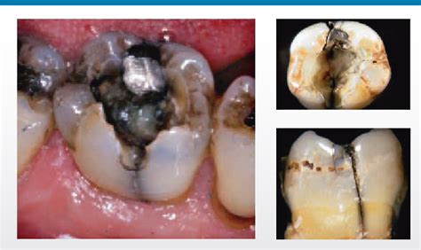 Figure 1 from Acute dental pain II: pulpal and periapical pain ...