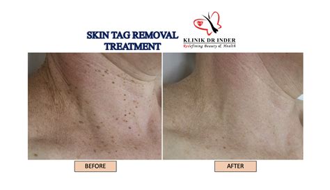 Skin Tag Treatment - Aesthetic Clinic Malaysia - Klinik Dr Inder