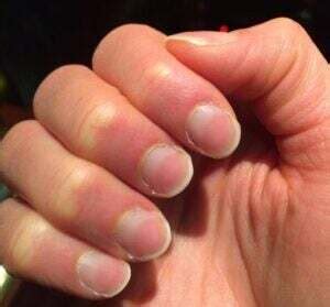 Kidney Disease and Nails: Possible Nail Symptoms