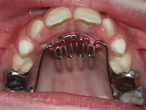 Tongue Thrust - Impact Myofunctional Therapy