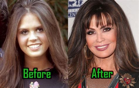 Marie Osmond Plastic Surgery: Facelift, Nose Job, Before-After ...