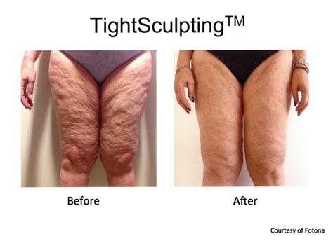 Body laser skin tightening – Artofit