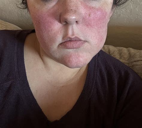 Is this a malar rash? : r/Autoimmune