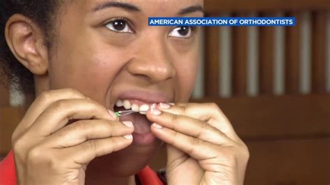 Orthodontic experts warn against DIY braces - ABC7 San Francisco