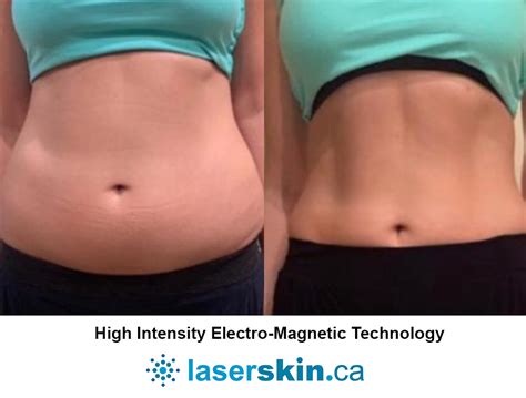 Body Contouring Before and After | LASERSKIN.CA Toronto