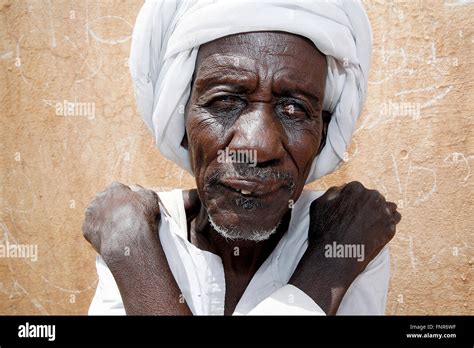 Leprosy patient known also as Leper,a disease called by Mycobacterium ...