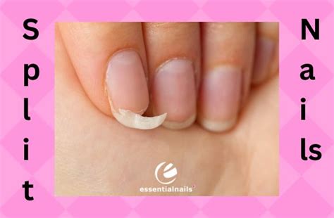 Mastering Nail Split Repairs | Essential Nails