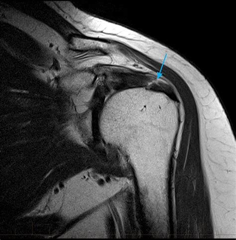 mri-shoulder-supraspinatus-tendon-tear - MRI at Melbourne Radiology Clinic