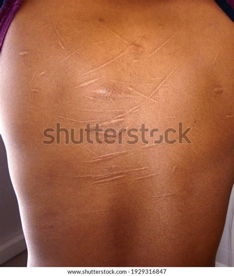 91 Whipping Scars Images, Stock Photos, 3D objects, & Vectors ...