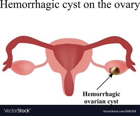 Hemorrhagic cyst on the ovary ovary infographics Vector Image