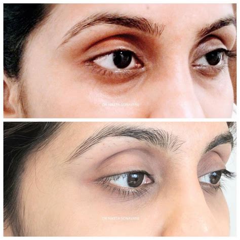 Under Eye Filler: Benefits, Costs, And What To Expect, 51% OFF