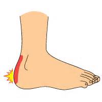 Heel Bursitis ← Tendonitis of Foot