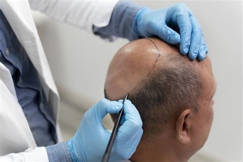 DHI Hair Transplant: What Is It, The Cost, And More - MyCapil ️