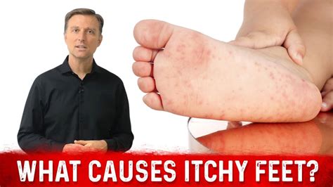 What Causes Itchy Feet and How to Stop It? – Dr. Berg - YouTube