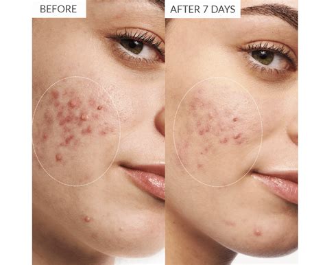 Vinopure: the natural solution for acne-prone skin | Caudalie® - Caudalie