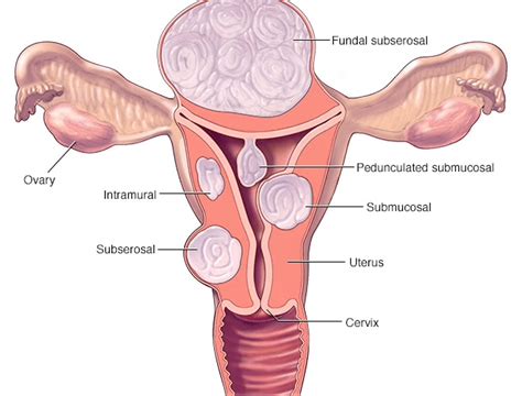 Types of Uterine Fibroids | Best Treatment for Fibroids in Trivandrum