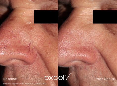 Thread Veins Facial Redness Treatment Royal Tunbridge Wells UK