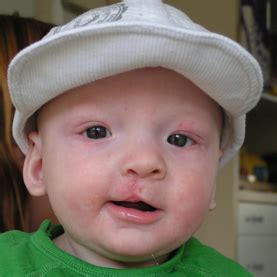 Cleft lip and palate history and symptoms - wikidoc