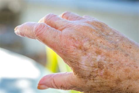 What Do You Need to Know if Your Senior Is Bruising More Often? - Home Care Matters