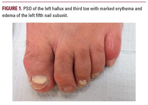 Proximal Subungual Onychomycosis