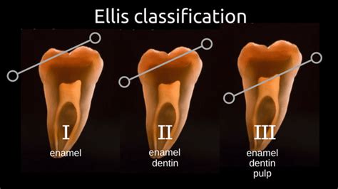 Deciduous dental damage