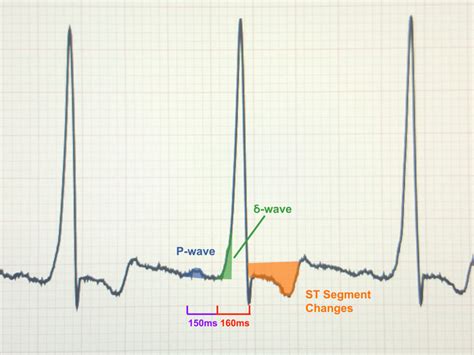 Wolff Parkinson White Syndrome - Causes, Symptoms, Treatment