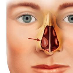 Turbinate Reduction - Raleigh Capitol Sinus & Allergy Center